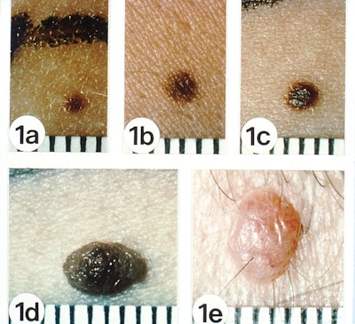 656px Non Melanoma 01