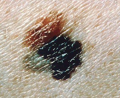 733px Melanoma (4)