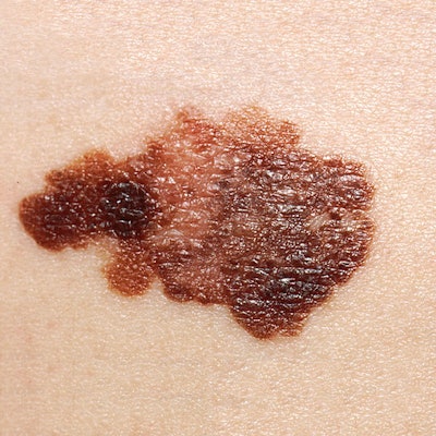 600px Melanoma (2) 0