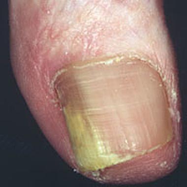 Nailclinic Onychomychosis