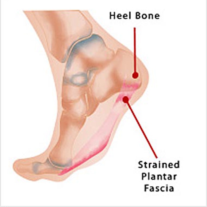 Nailclinic Plantarfasciitis