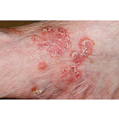 Nailclinic Psoriasis1