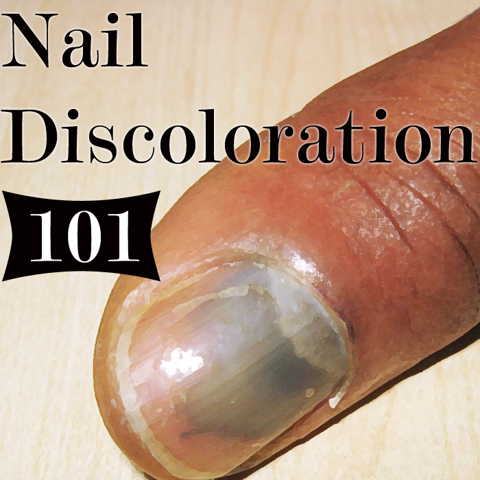 Np Cover Nail Discoloration Means