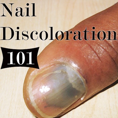 Np Cover Nail Discoloration Means
