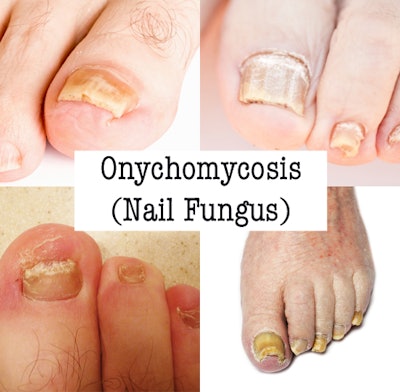 Onychomycosis 0