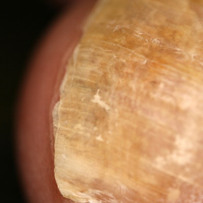 Thick Toenails Why