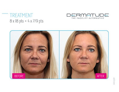 Lonneke-before-and-after