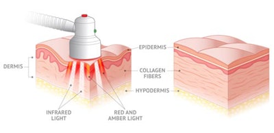 Quasar+MD+Red%27s+action+on+the+skin