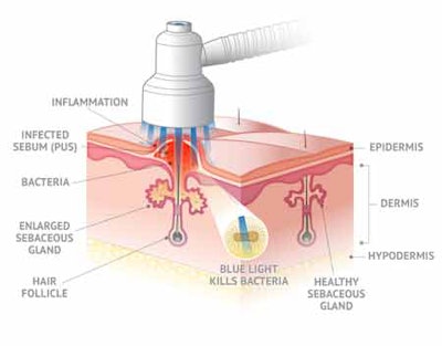 Quasar+MD+Blue%27s+action+on+the+skin