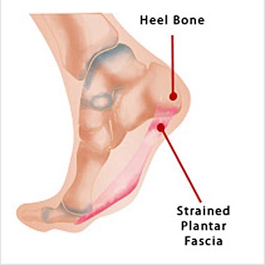 Nail Clinic: Plantar Fasciitis