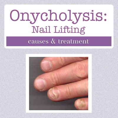 Nail Clinic: Onycholysis: What It Looks Like, Causes, and Treatment