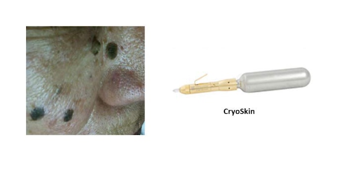 Cryoskin_np1