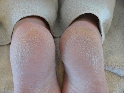 NP-Four-Foot-Problems-Athlete’s-Foot