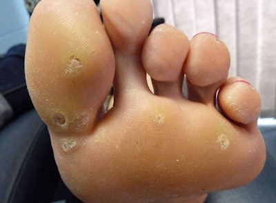 NP-Four-Foot-Problems-Plantar-Wart