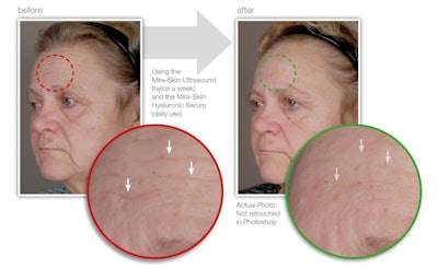 The affect on wrinkles