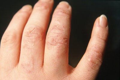 allergy
