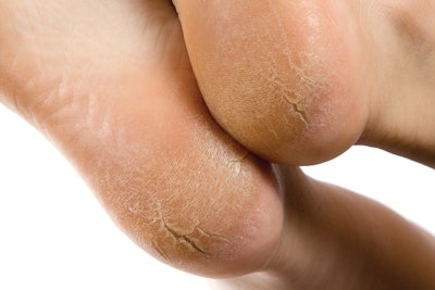 Dry and cracked soles of feet on white background