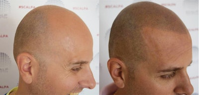 Micropigmentation