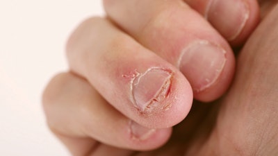 getty image damaged nail
