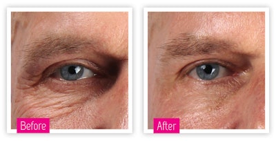 Dermatude Si1708 Beforeafter1