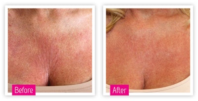 Dermatude Si1708 Beforeafter2