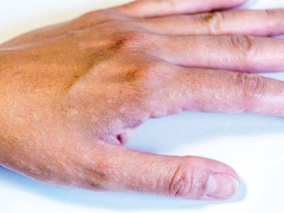 Hand with Eczema