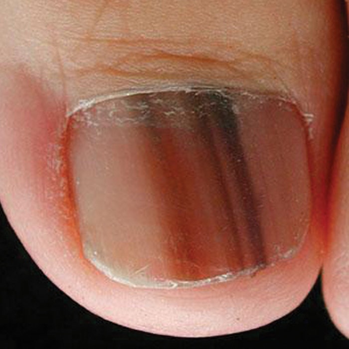 nail-melanoma