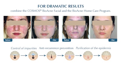 Bio Acne800x424 Ba