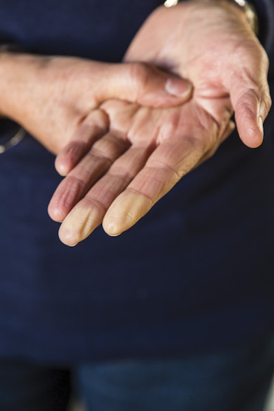 Raynaud’s-Syndrome