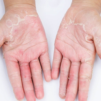 Understanding-Psoriasis