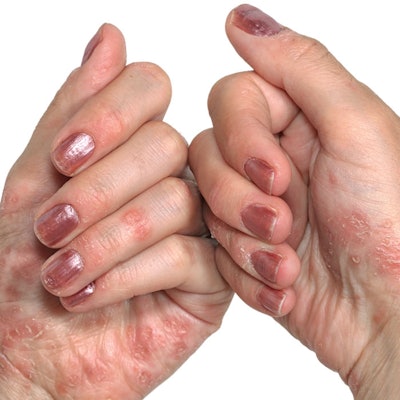understanding-psoriasis
