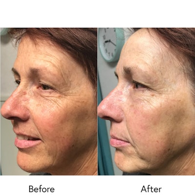 reveal-skincare-before-after