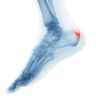 heel-spurs-quiz