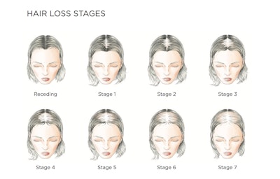 This hair loss chart helps to determine which Transformations pieces will work best.