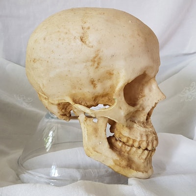 Temporomandibular-Joint-pain