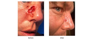 A male patient after a removal of severe skin cancer in the nose area. Cell therapy was used for faster recovery for 23 days. Epidermal and dermal growth was observed, and no skin graft was needed.