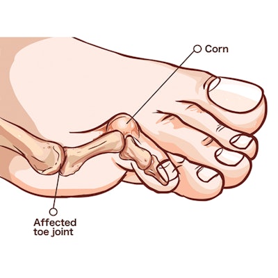 hammertoe-relief
