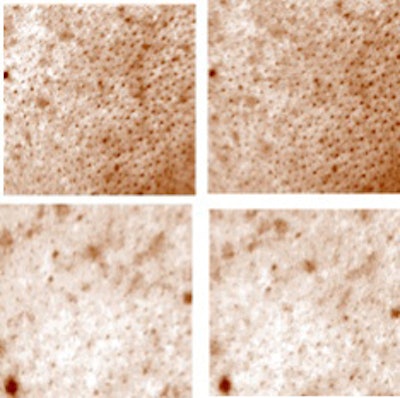 Figure 2 Brown Spots of the right side of face before (Left) and after (Right) 4 weeks’ application.