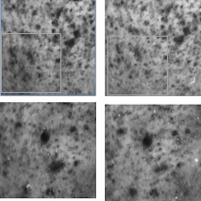 Figure 3 UV Spots of the right side of face before (Left) and after (Right) 4 weeks’ application.