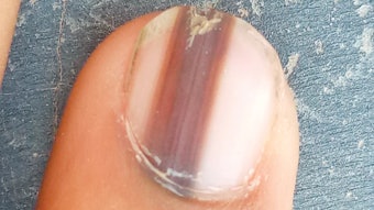 Nail techs are in a position to notice a rare and dangerous type of cancer in the nail when doing a service. Here, we discuss subungual melanoma, a type of skin cancer under the nail.