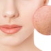 Neoporyl is a cosmetic ingredient that was clinically proven to reduce pore size in just one week. Crafted by biocatalysis, it targets the root causes of enlarged pores by acting on parakeratosis and dermis fragility.