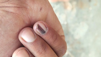 These six changes in nails could be a sign of a health problem. Make sure you recognize them, so you can refer your client to a medical professional.