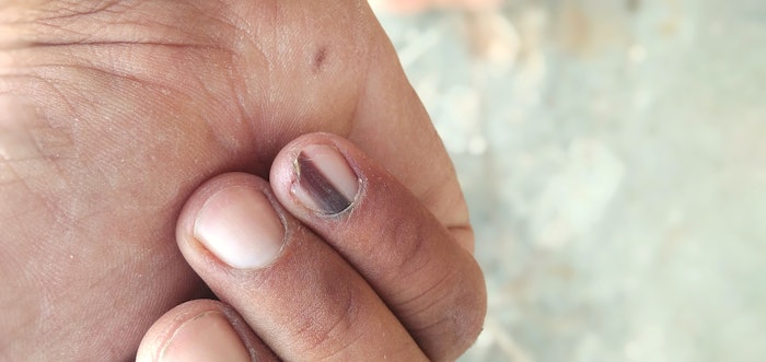 These six changes in nails could be a sign of a health problem. Make sure you recognize them, so you can refer your client to a medical professional.