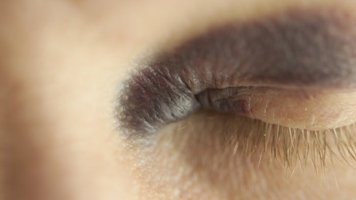 Bruising around the eye