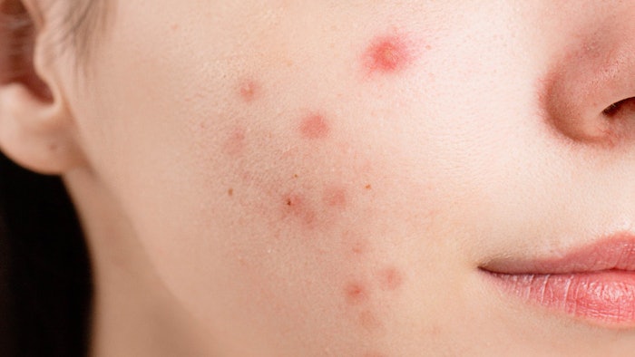 Young woman with acne.