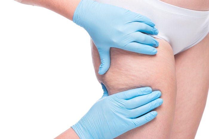 Doctor examines thigh cellulite