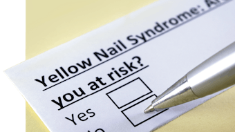 Experts share the signs and symptoms of Yellow Nail Syndrome.