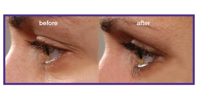 Rocasuba Beforeafter 850x425