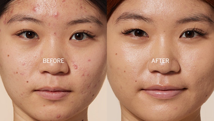 before and after pics of woman after acne treatment