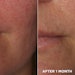 Woman before and after smile lines treatment